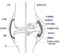 關節(jié)炎癥狀表現(xiàn)